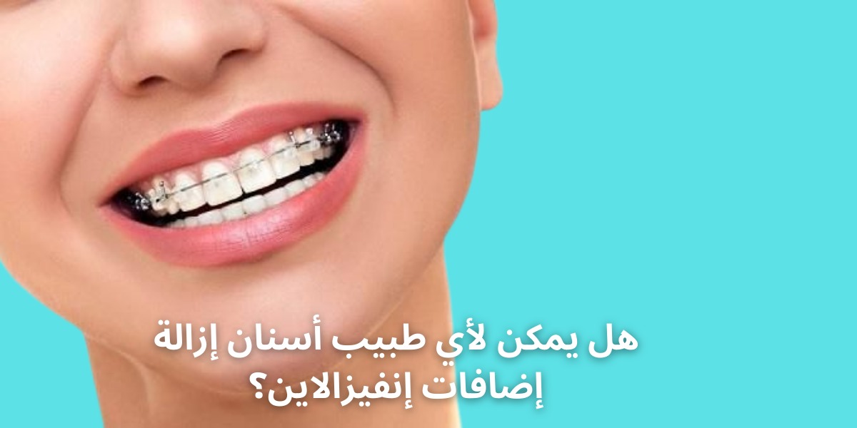 هل يمكن لأي طبيب أسنان إزالة إضافات إنفيزالاين؟